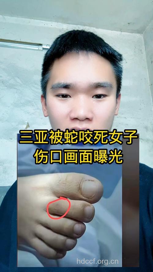 金环蛇、海蛇咬伤症状