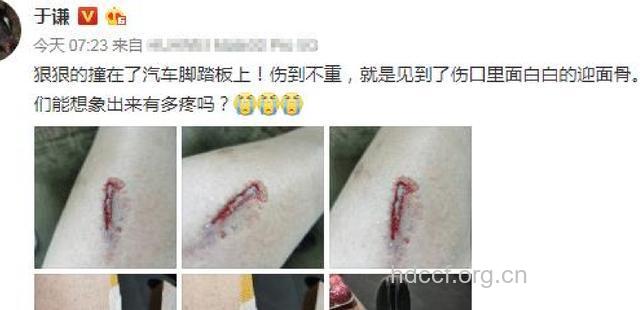 车祸最易受伤的部位有哪些