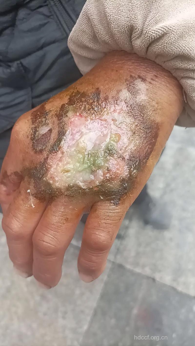 烧伤感染创面的治疗用药