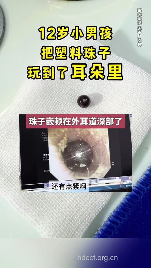 怎么取出耳内异物方法