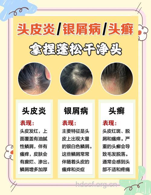 哪些因素易导致头皮屑