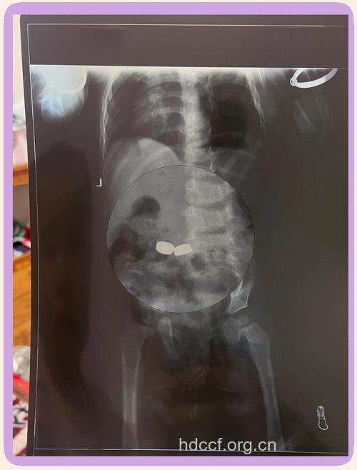 女婴食道中取出金属片