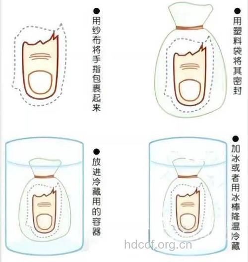断指如何保存才能更好接上