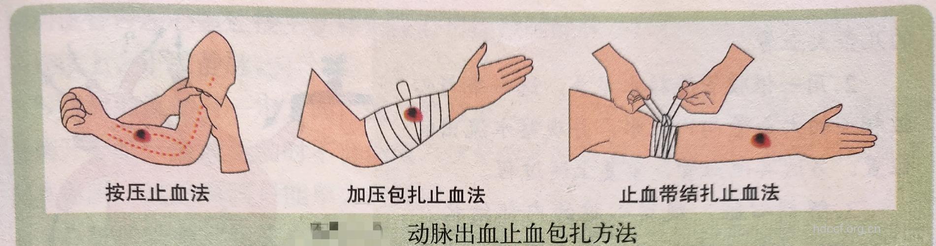 动脉出血如何急救处理