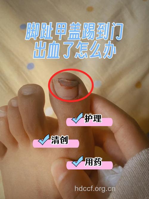指甲出血的应急技巧