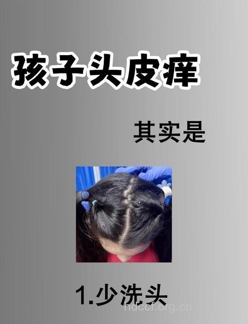 哪些小习惯可消除头皮屑