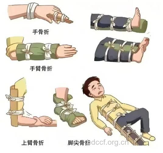 关于骨折怎么正确急救方法