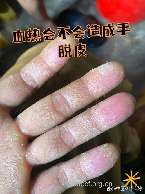 哪些中医验方可治疗手掌脱皮