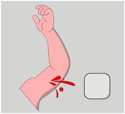 外伤大出血要按住动脉常识