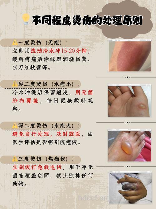 烫伤后的水疱不可挑破