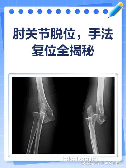 肘关节脱位的急救方法