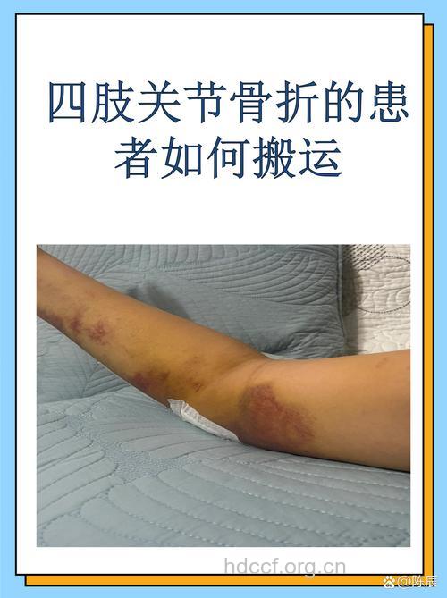 骨折病人现场转运常识