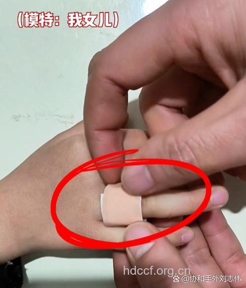 小儿手指夹伤如何救治方法