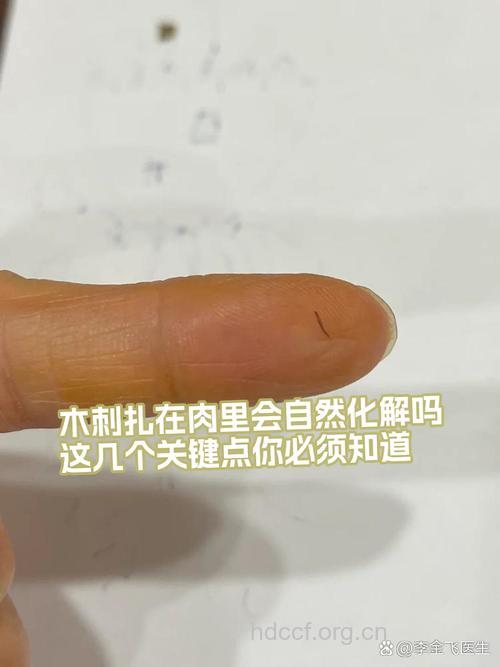 怎么挑出肉中刺方法