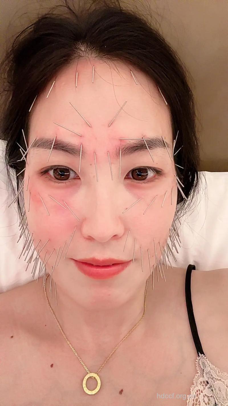 针灸美容有哪些特点