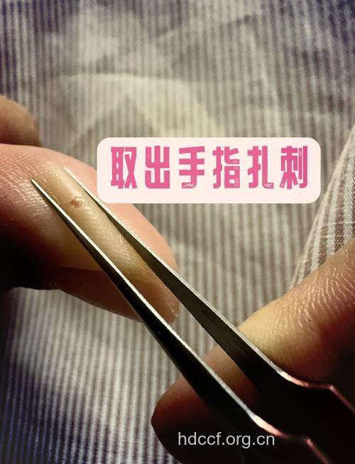 怎么挤出扎在手中的小木刺