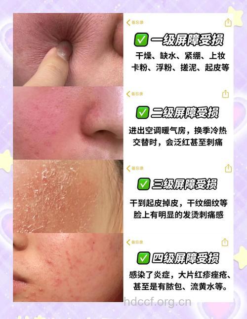 皮肤过敏有哪些护理方法