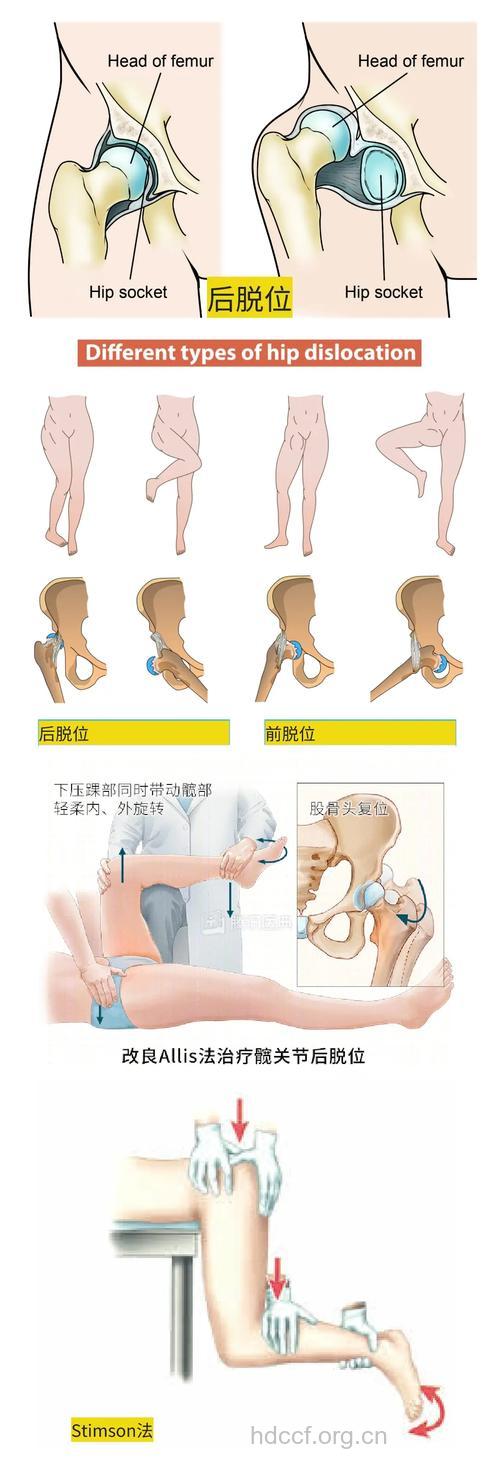 身体各部位脱位处理大全