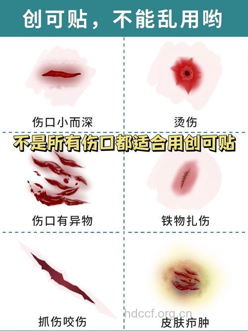这样的伤口不能使用创可贴