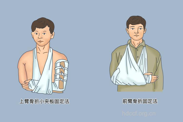 骨折后的固定技术