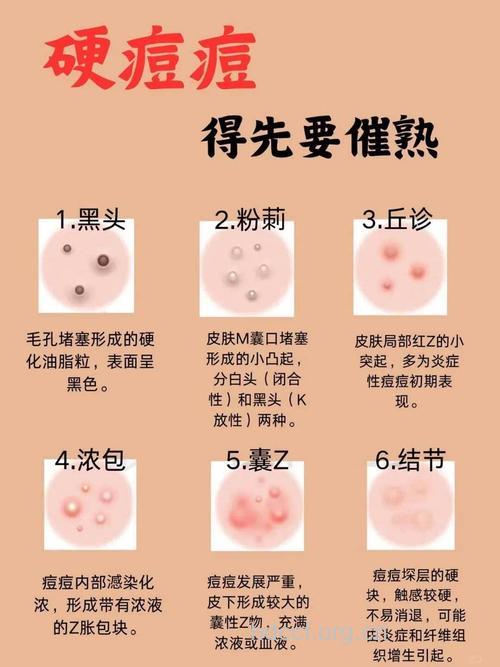 湿热淤积痘痘横生怎么办