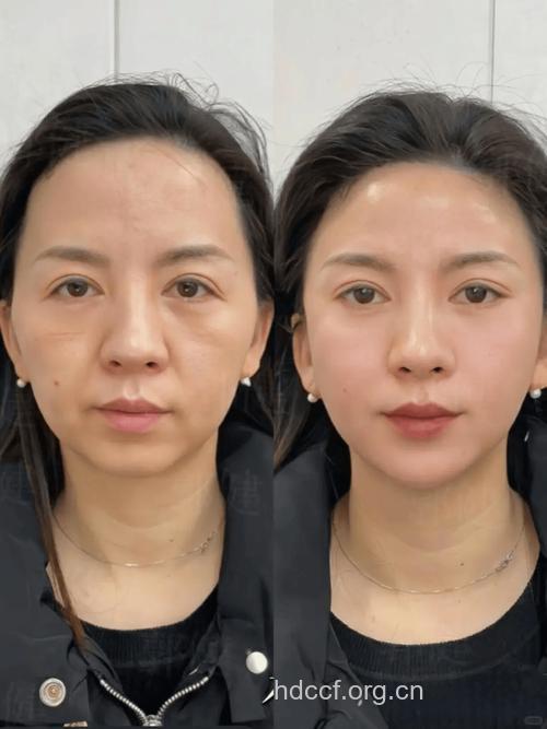 不同年龄的女性抗皱纹