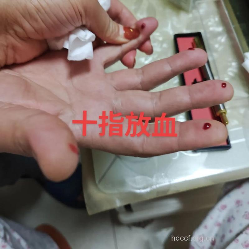 大量出血 指压制止