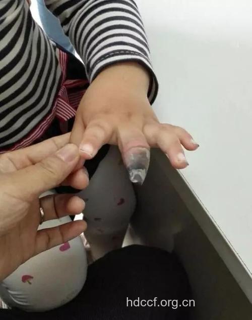 错误使用创可贴,宝宝被迫截指