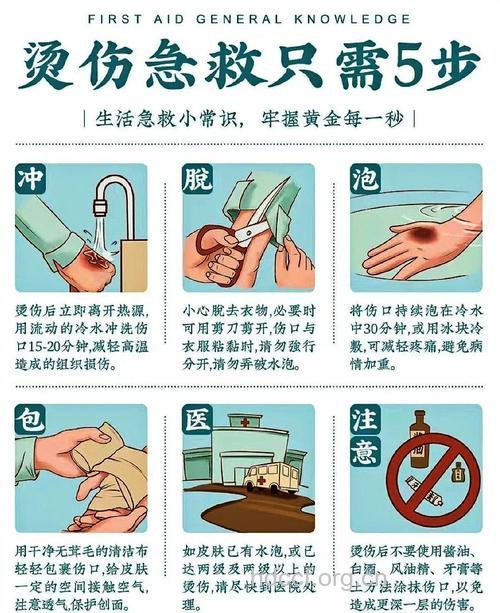 烧伤急救谨记“五字诀”