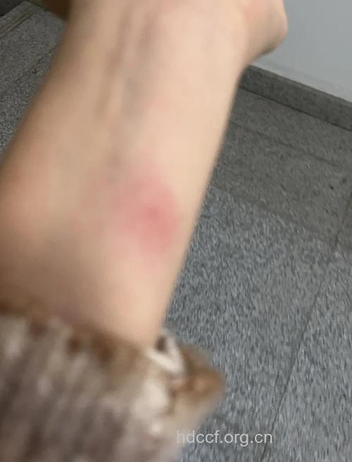 感冒药 可能干扰青霉素皮试结果