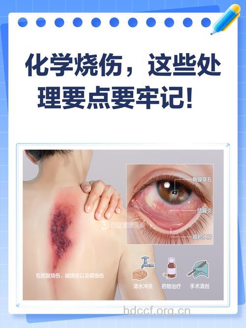 受化学伤害的处理原则