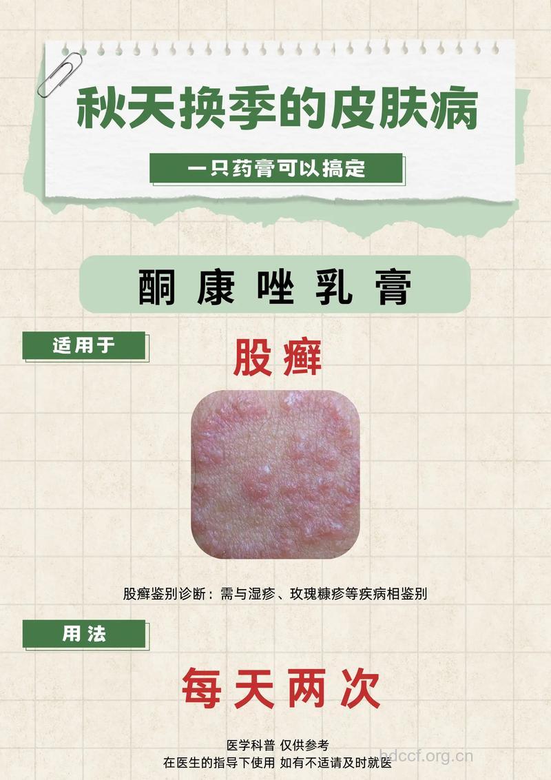 得了股癣,如何治疗用药?