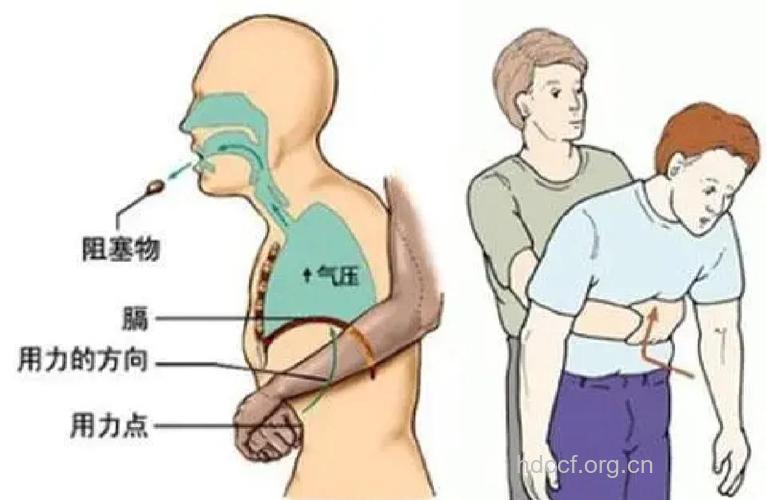 成人异物卡喉的急救方法
