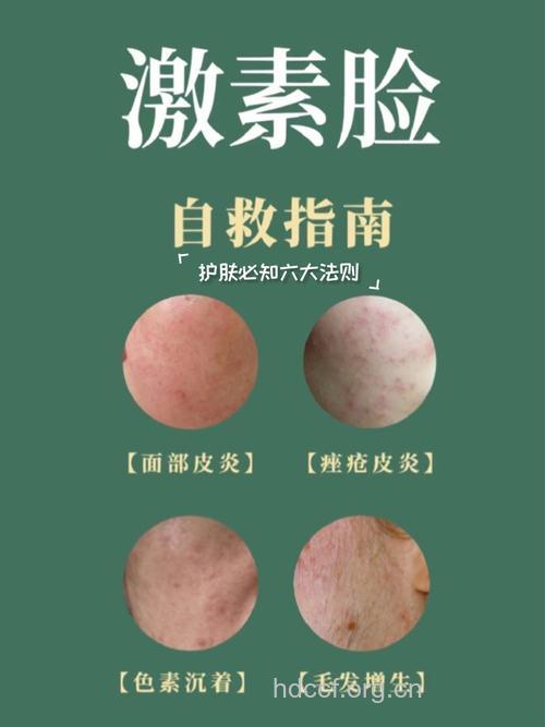 脸上可以涂抹激素吗?