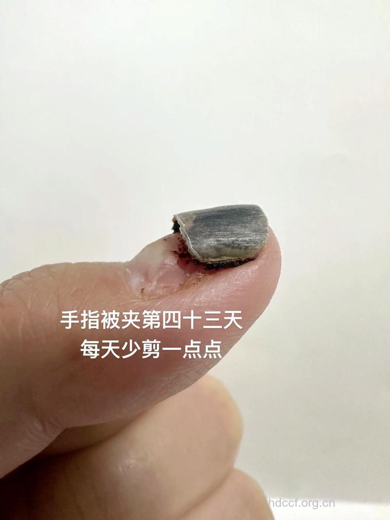 指甲受伤了怎么办？