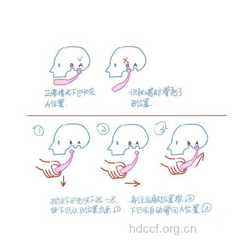 下巴脱臼怎么办?