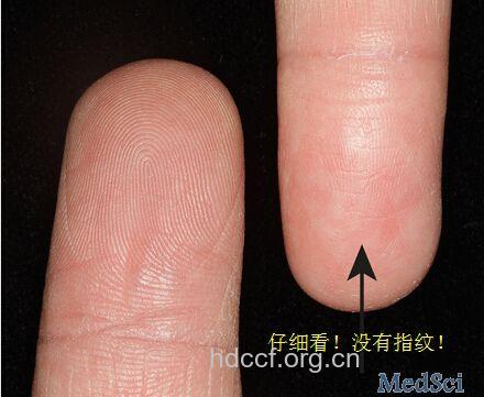抗癌药物导致指纹暂时消失?