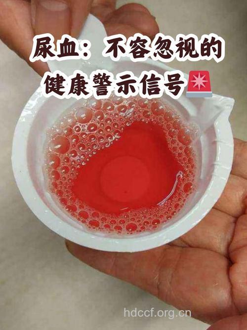 儿童服用感冒通后可引起的血尿