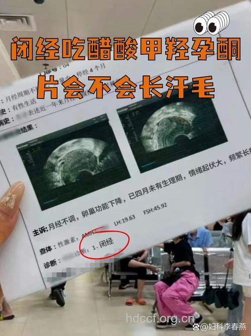 药物也可导致女性多毛?