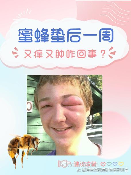 食用蜂蜜也会引起过敏?