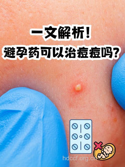 吃避孕药治疗痘痘,男人胸部惊发育