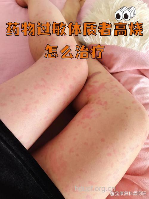 康泰克也会导致过敏反应