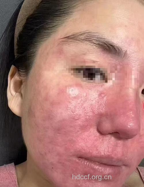 皮肤乱用外用药 小心变成了“大花脸”