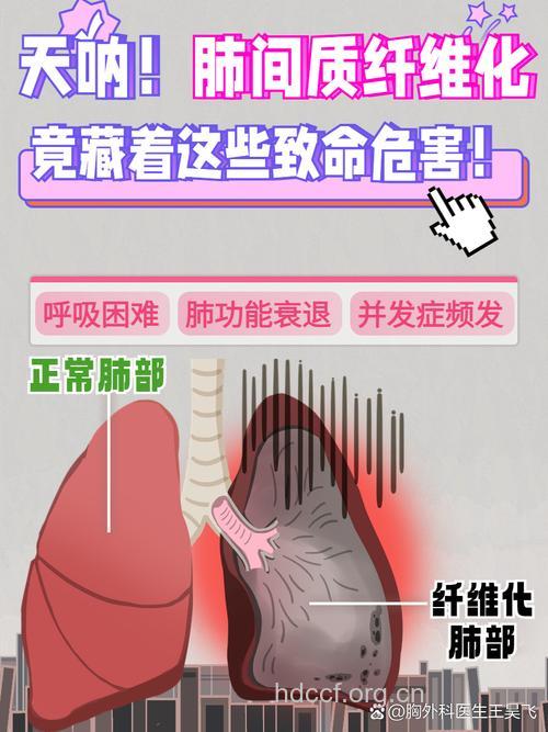 滥用激素、抗生素 小心导致肺纤维化