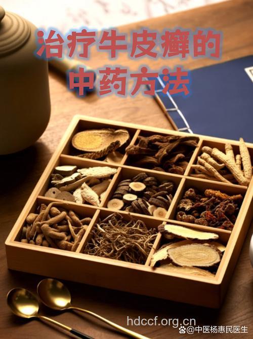 中药治疗牛皮癣的五大误区