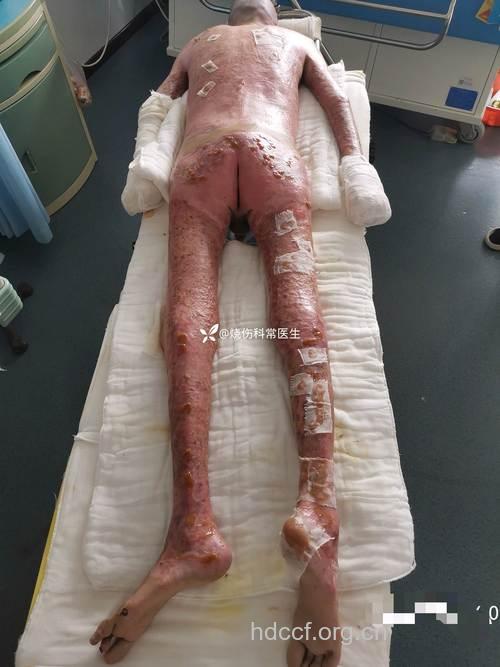 感冒药“烧伤”全身 98％皮肤