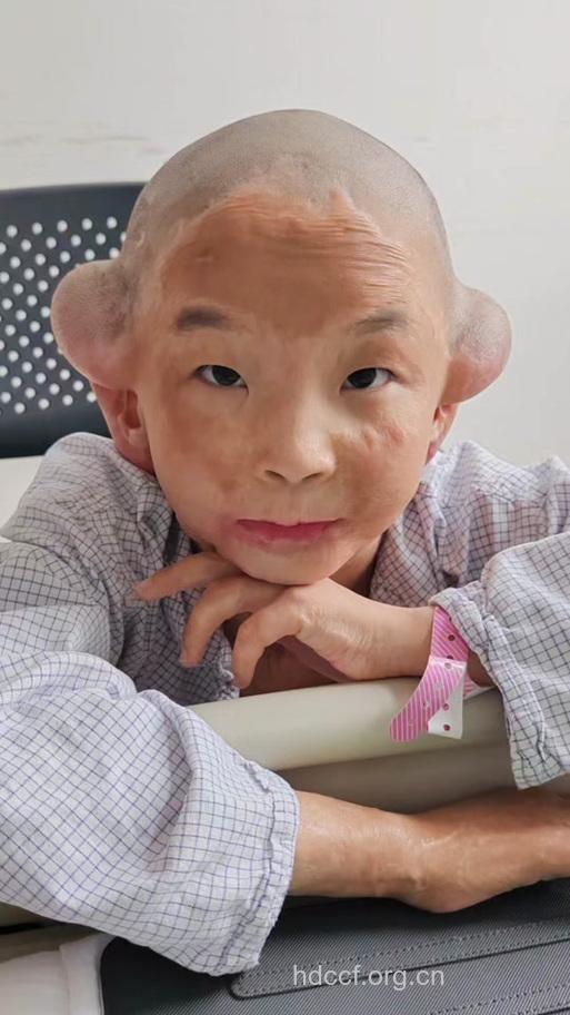 使用激素十年 男孩竟成“怪物”