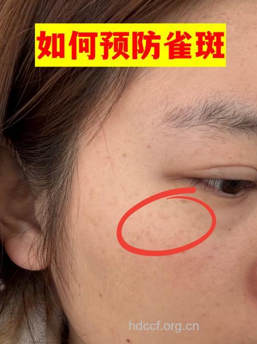 防黑斑、雀斑――维生素C