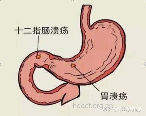消化性溃疡临床愈合后仅需晚间服药