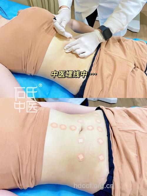 埋线减肥有效果 并且不容易反弹
